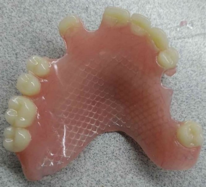 Prótesis dentales parciales acrílicas reforzadas con malla